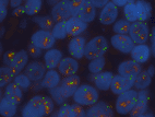 Image: Breast Cancer Specimen stained with the Leica HER2 FISH System showing amplification of the HER2 gene (Photo courtesy of Leica Microsystems).